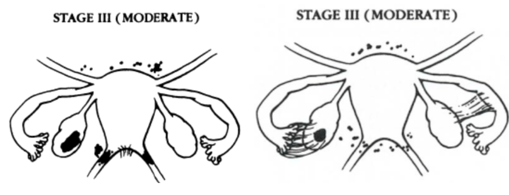 Endometriosis: Symptoms, Causes and Treatment