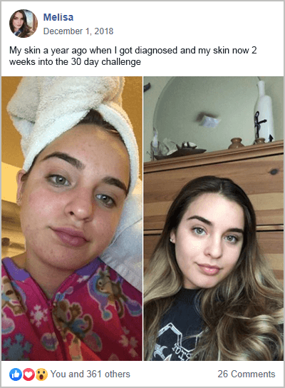 Melisa PCOS Acne Success Story